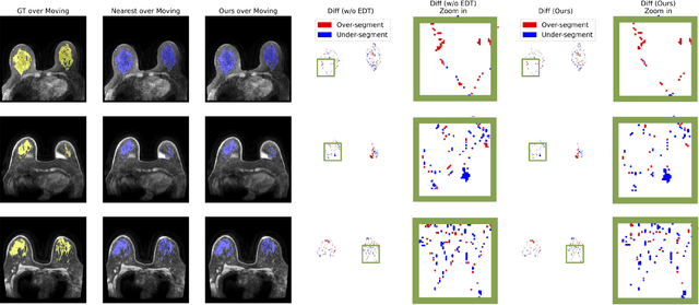 Figure 3 for GuidedMorph: Two-Stage Deformable Registration for Breast MRI