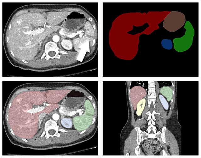 Figure 4 for The RSNA Abdominal Traumatic Injury CT (RATIC) Dataset