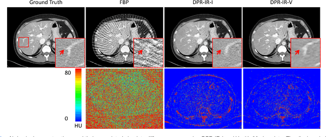 Figure 3 for Diffusion Prior Regularized Iterative Reconstruction for Low-dose CT