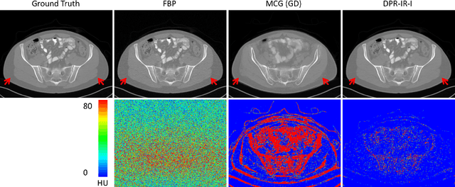 Figure 4 for Diffusion Prior Regularized Iterative Reconstruction for Low-dose CT