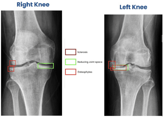 Figure 4 for A Multi-Site Study on AI-Driven Pathology Detection and Osteoarthritis Grading from Knee X-Ray