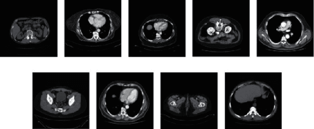 Figure 2 for A CT Image Denoising Method with Residual Encoder-Decoder Network