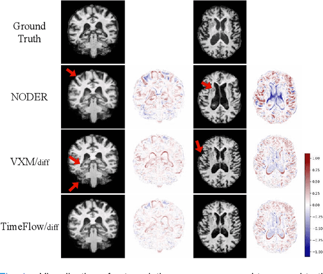Figure 4 for TimeFlow: Longitudinal Brain Image Registration and Aging Progression Analysis