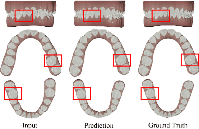 Figure 1 for Automatic Tooth Arrangement with Joint Features of Point and Mesh Representations via Diffusion Probabilistic Models