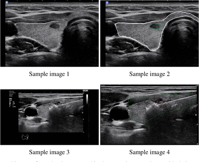 Figure 3 for E2E-Swin-Unet++: An Enhanced End-to-End Swin-Unet Architecture With Dual Decoders For PTMC Segmentation