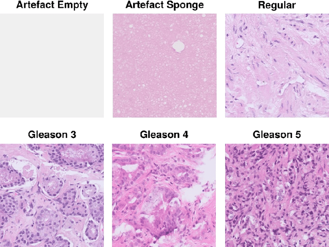 Figure 3 for DeepGleason: a System for Automated Gleason Grading of Prostate Cancer using Deep Neural Networks