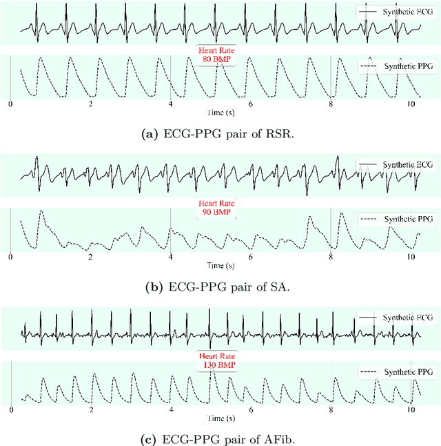 Figure 3 for CLEP-GAN: An Innovative Approach to Subject-Independent ECG Reconstruction from PPG Signals