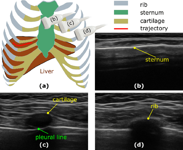 Figure 1 for Class-Aware Cartilage Segmentation for Autonomous US-CT Registration in Robotic Intercostal Ultrasound Imaging