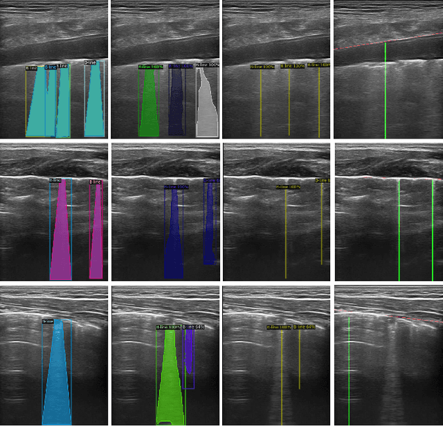 Figure 4 for A Semi-supervised Learning Approach for B-line Detection in Lung Ultrasound Images