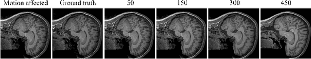 Figure 3 for Assessing the use of Diffusion models for motion artifact correction in brain MRI