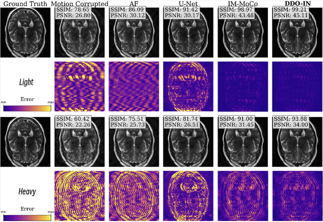 Figure 3 for DDO-IN: Dual Domains Optimization for Implicit Neural Network to Eliminate Motion Artifact in Magnetic Resonance Imaging