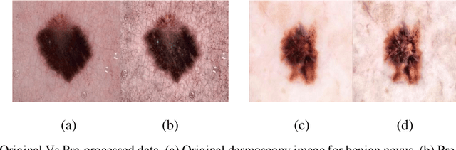Figure 1 for A Comparative Analysis of Transfer Learning-based Techniques for the Classification of Melanocytic Nevi