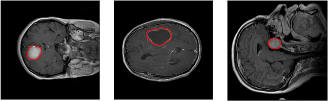 Figure 1 for A Deep Learning Approach for Brain Tumor Classification and Segmentation Using a Multiscale Convolutional Neural Network