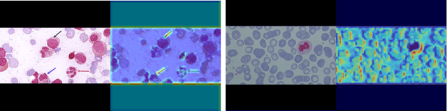 Figure 1 for Novel Pipeline for Diagnosing Acute Lymphoblastic Leukemia Sensitive to Related Biomarkers