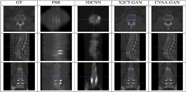 Figure 2 for Coarse-Fine View Attention Alignment-Based GAN for CT Reconstruction from Biplanar X-Rays