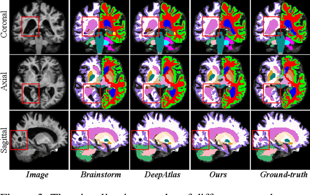 Figure 4 for Robust One-shot Segmentation of Brain Tissues via Image-aligned Style Transformation