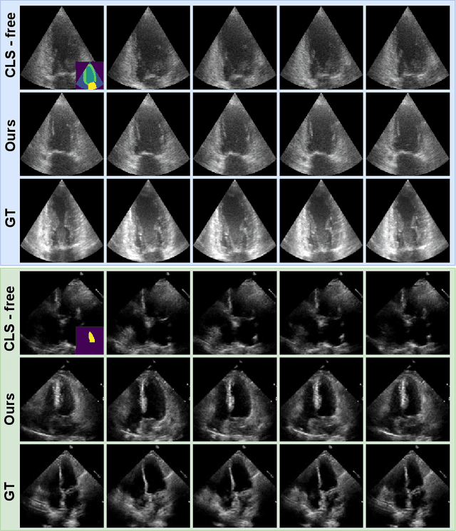 Figure 3 for Training-Free Condition Video Diffusion Models for single frame Spatial-Semantic Echocardiogram Synthesis