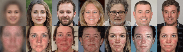 Figure 1 for Interpretable Automatic Rosacea Detection with Whitened Cosine Similarity