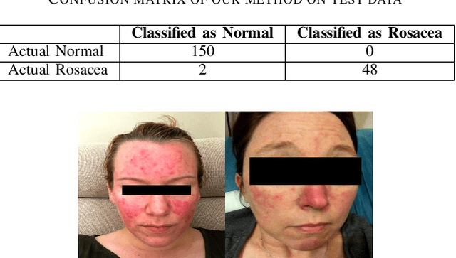 Figure 3 for Interpretable Automatic Rosacea Detection with Whitened Cosine Similarity