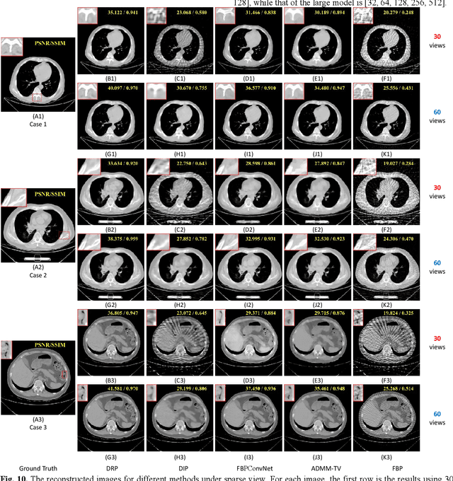 Figure 2 for Deep Radon Prior: A Fully Unsupervised Framework for Sparse-View CT Reconstruction