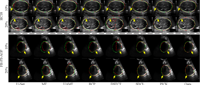 Figure 2 for ERSR: An Ellipse-constrained pseudo-label refinement and symmetric regularization framework for semi-supervised fetal head segmentation in ultrasound images