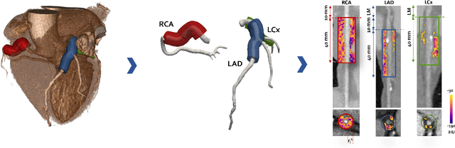 Figure 3 for Pericoronary adipose tissue attenuation as a predictor of functional severity of coronary stenosis