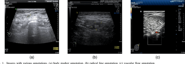 Figure 1 for Ultrasonic Image's Annotation Removal: A Self-supervised Noise2Noise Approach