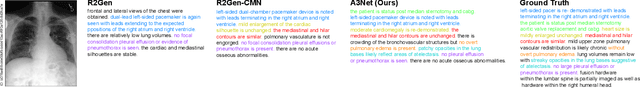 Figure 4 for Anatomical Attention Alignment representation for Radiology Report Generation