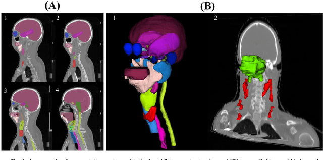 Figure 1 for Fully Automatic Segmentation of Gross Target Volume and Organs-at-Risk for Radiotherapy Planning of Nasopharyngeal Carcinoma