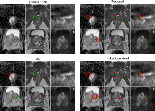 Figure 3 for Weakly supervised localisation of prostate cancer using reinforcement learning for bi-parametric MR images