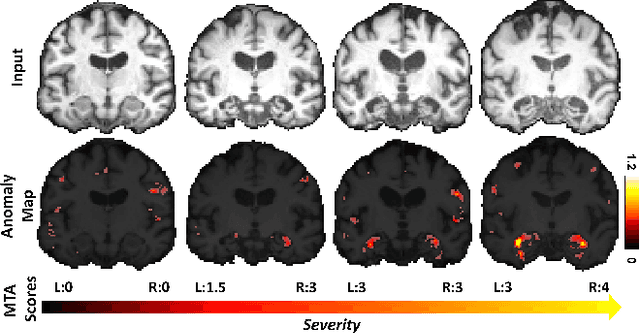 Figure 4 for Unsupervised Analysis of Alzheimer's Disease Signatures using 3D Deformable Autoencoders
