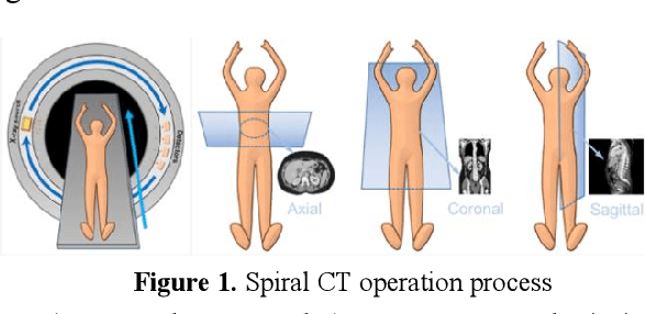Figure 1 for Application analysis of ai technology combined with spiral CT scanning in early lung cancer screening
