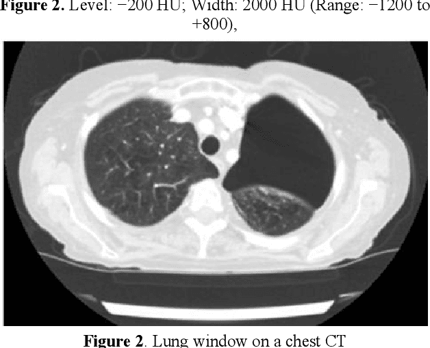 Figure 2 for Application analysis of ai technology combined with spiral CT scanning in early lung cancer screening