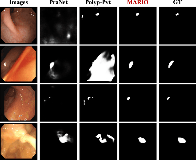 Figure 3 for MARIO: A Mixed Annotation Framework For Polyp Segmentation