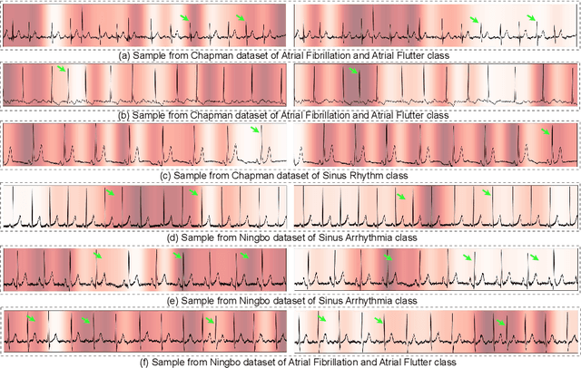 Figure 4 for EXGnet: a single-lead explainable-AI guided multiresolution network with train-only quantitative features for trustworthy ECG arrhythmia classification