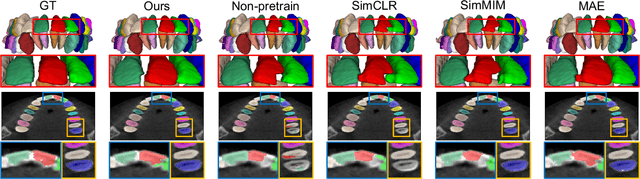 Figure 3 for Sparse Anatomical Prompt Semi-Supervised Learning with Masked Image Modeling for CBCT Tooth Segmentation