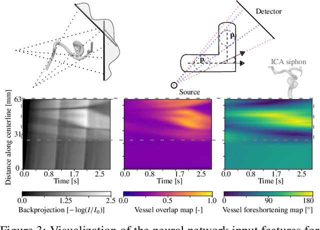 Figure 4 for Physics-Informed Learning for Time-Resolved Angiographic Contrast Agent Concentration Reconstruction