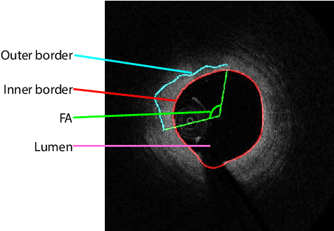Figure 1 for FiAt-Net: Detecting Fibroatheroma Plaque Cap in 3D Intravascular OCT Images