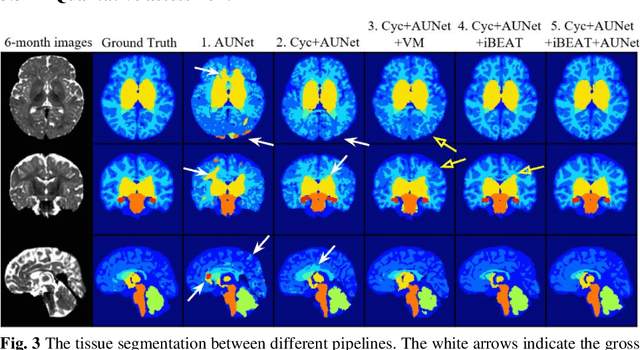 Figure 4 for Automatic 8-tissue Segmentation for 6-month Infant Brains