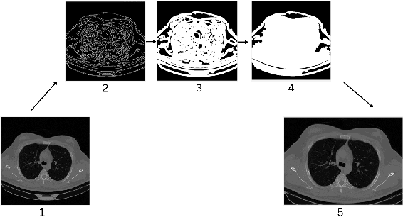 Figure 3 for Pneumonia Diagnosis through pixels -- A Deep Learning Model for detection and classification