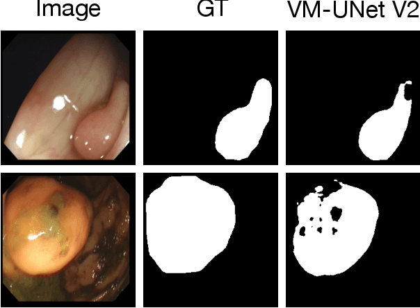 Figure 1 for Topo-VM-UNetV2: Encoding Topology into Vision Mamba UNet for Polyp Segmentation