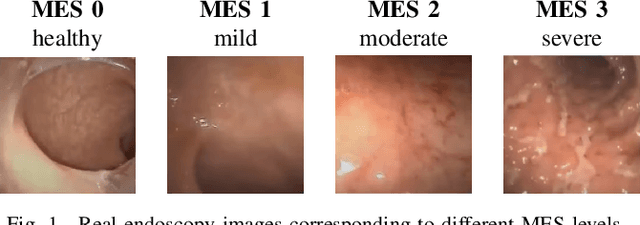 Figure 1 for Ulcerative Colitis Mayo Endoscopic Scoring Classification with Active Learning and Generative Data Augmentation