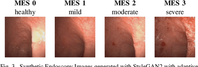 Figure 3 for Ulcerative Colitis Mayo Endoscopic Scoring Classification with Active Learning and Generative Data Augmentation