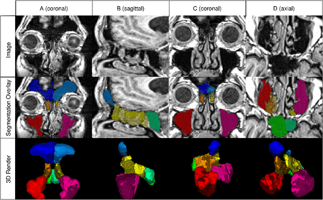 Figure 3 for PARASIDE: An Automatic Paranasal Sinus Segmentation and Structure Analysis Tool for MRI