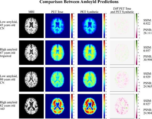 Figure 2 for Amyloid-Beta Axial Plane PET Synthesis from Structural MRI: An Image Translation Approach for Screening Alzheimer's Disease