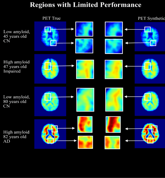 Figure 4 for Amyloid-Beta Axial Plane PET Synthesis from Structural MRI: An Image Translation Approach for Screening Alzheimer's Disease