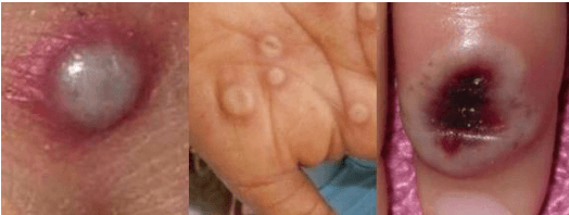 Figure 4 for Classification of Human Monkeypox Disease Using Deep Learning Models and Attention Mechanisms
