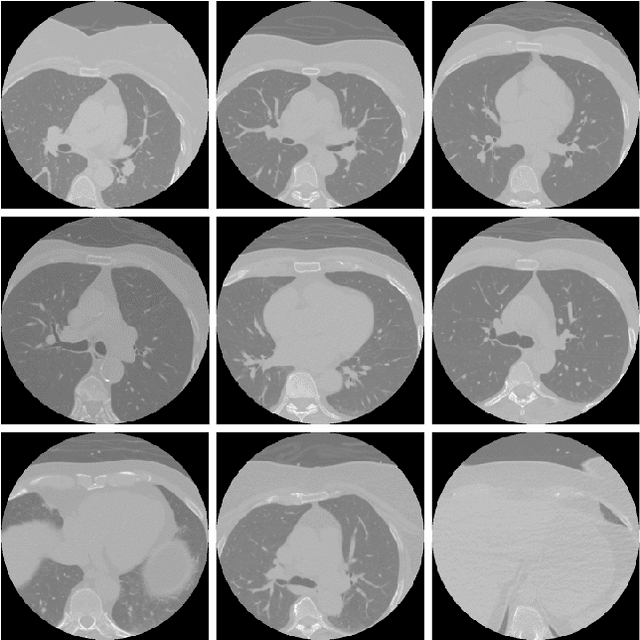 Figure 1 for Predicting Coronary Artery Calcium Severity based on Non-Contrast Cardiac CT images using Deep Learning