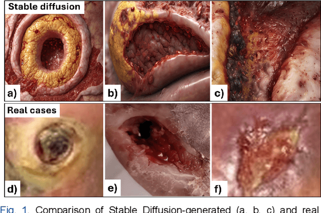 Figure 1 for Beyond Labels: Zero-Shot Diabetic Foot Ulcer Wound Segmentation with Self-attention Diffusion Models and the Potential for Text-Guided Customization