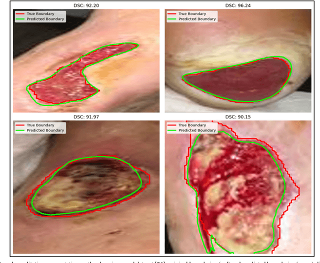 Figure 4 for Beyond Labels: Zero-Shot Diabetic Foot Ulcer Wound Segmentation with Self-attention Diffusion Models and the Potential for Text-Guided Customization